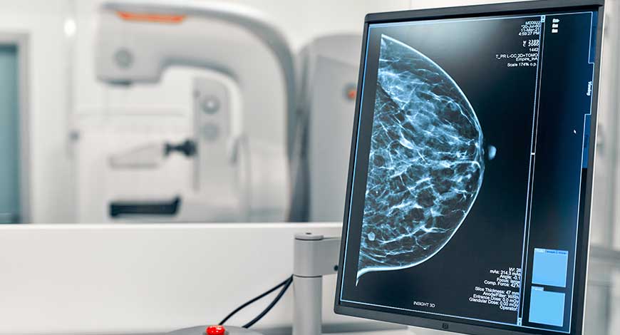 AI can predict the effectiveness of breast cancer chemotherapy